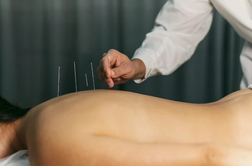 Top Benefits of Acupuncture for Stress Relief